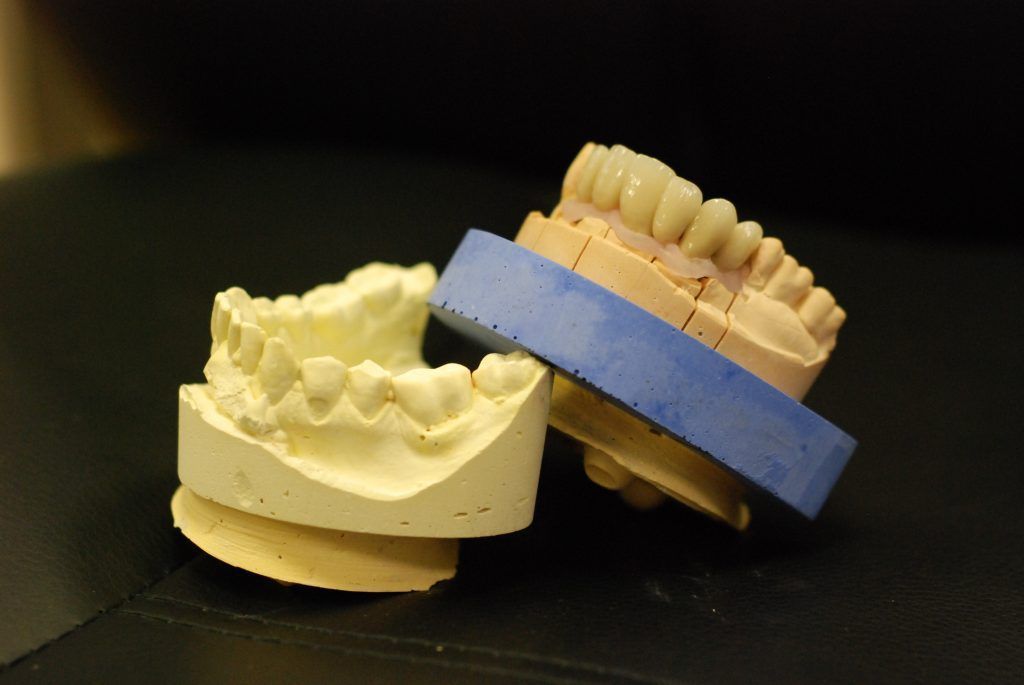 Prothèse conjointe de la mâchoire inférieure