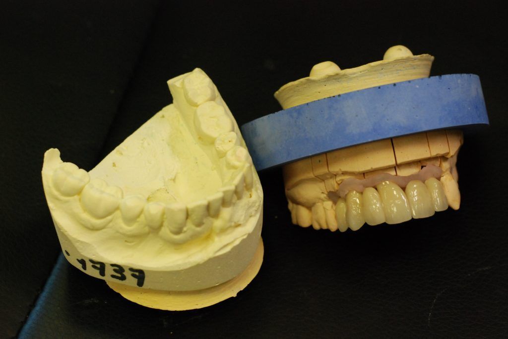 Prothèse conjointe de la mâchoire supérieure sous forme de bridge