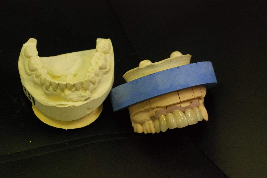 Prothèse conjointe de la mâchoire supérieure sur fond noir