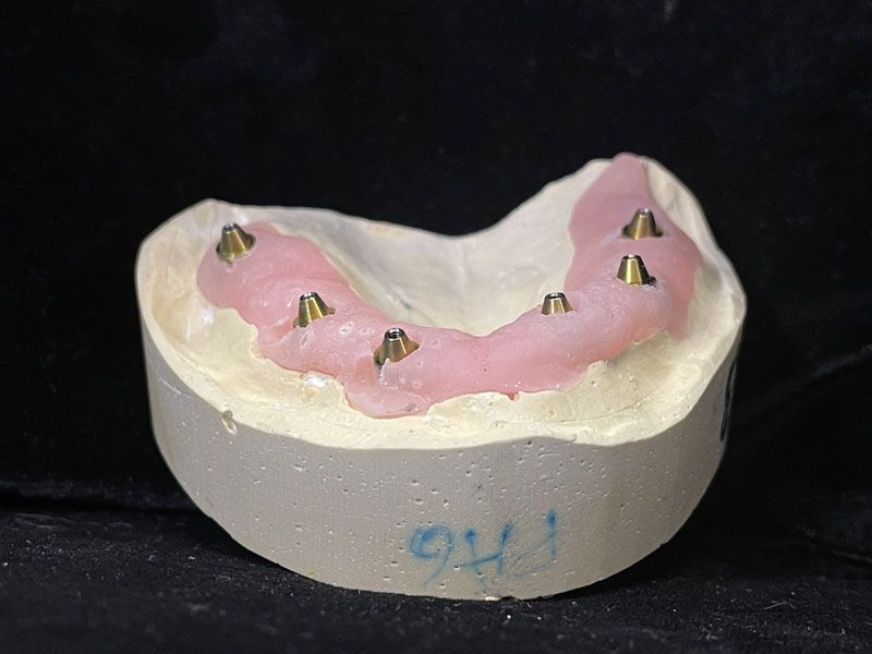 Six implants dentaires