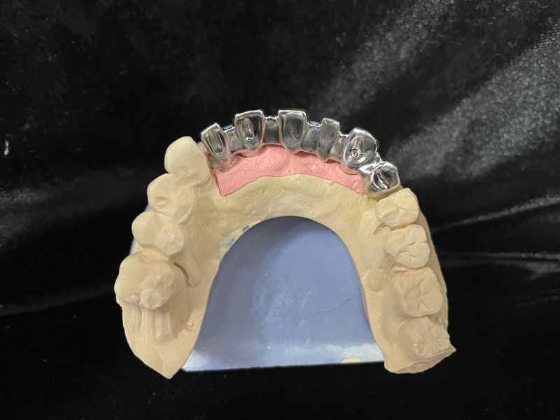 Prothèse conjointe céramométallique