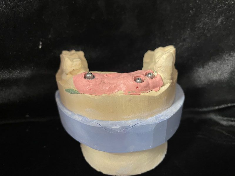 Implants pour prothèse conjointe vus de face