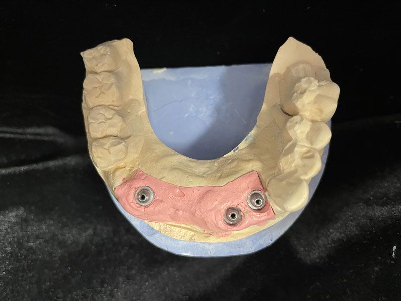 Implants pour prothèse conjointe vus de haut