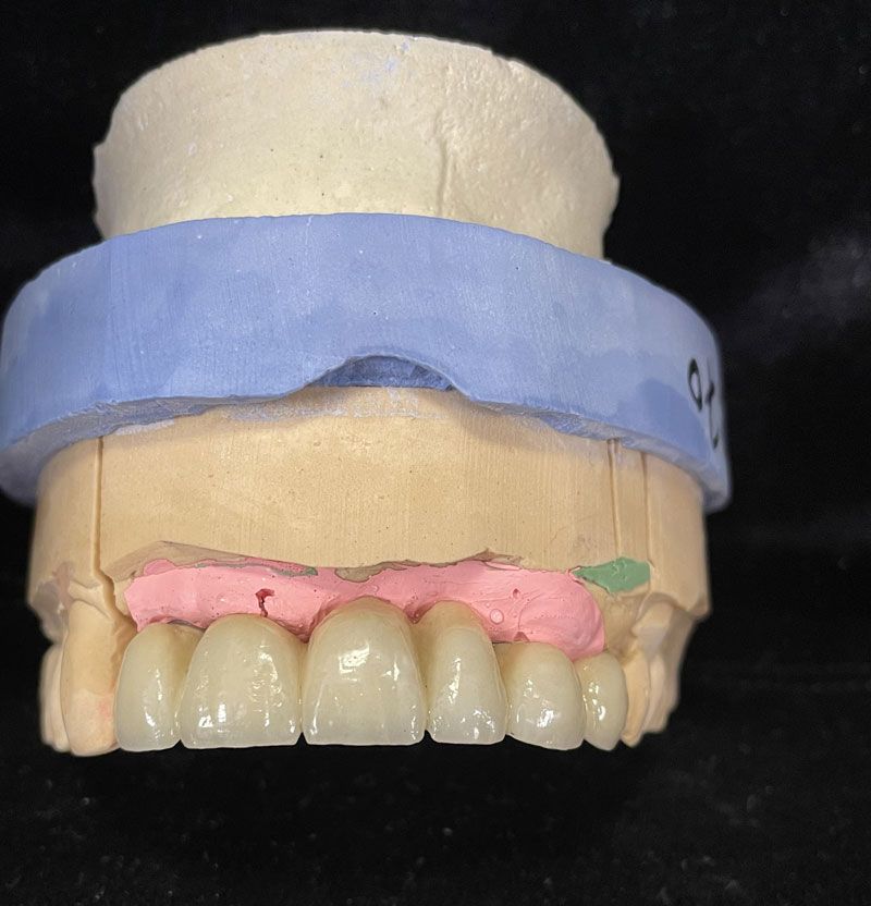 Prothèse conjointe en céramique sous forme de bridge