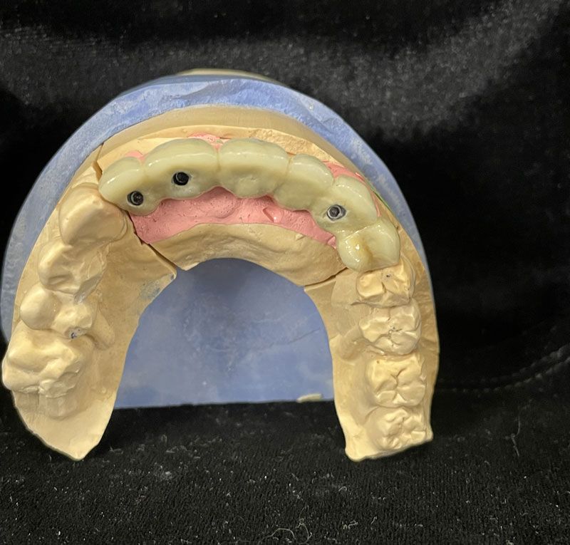 Prothèse conjointe en céramique