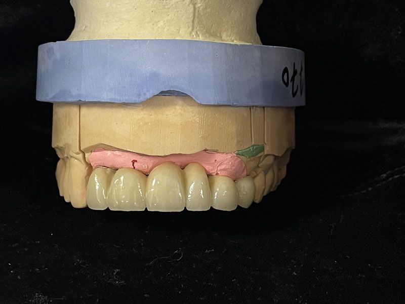 Prothèse conjointe en céramique vue de face