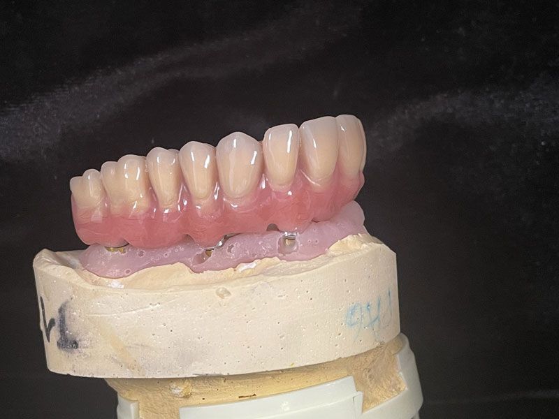Prothèse conjointe vue de côté