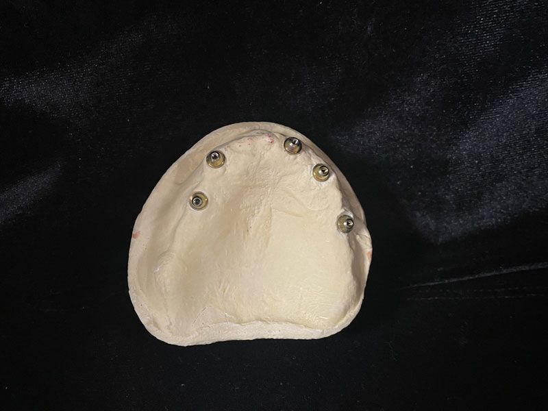 Cinq implants dentaires posés