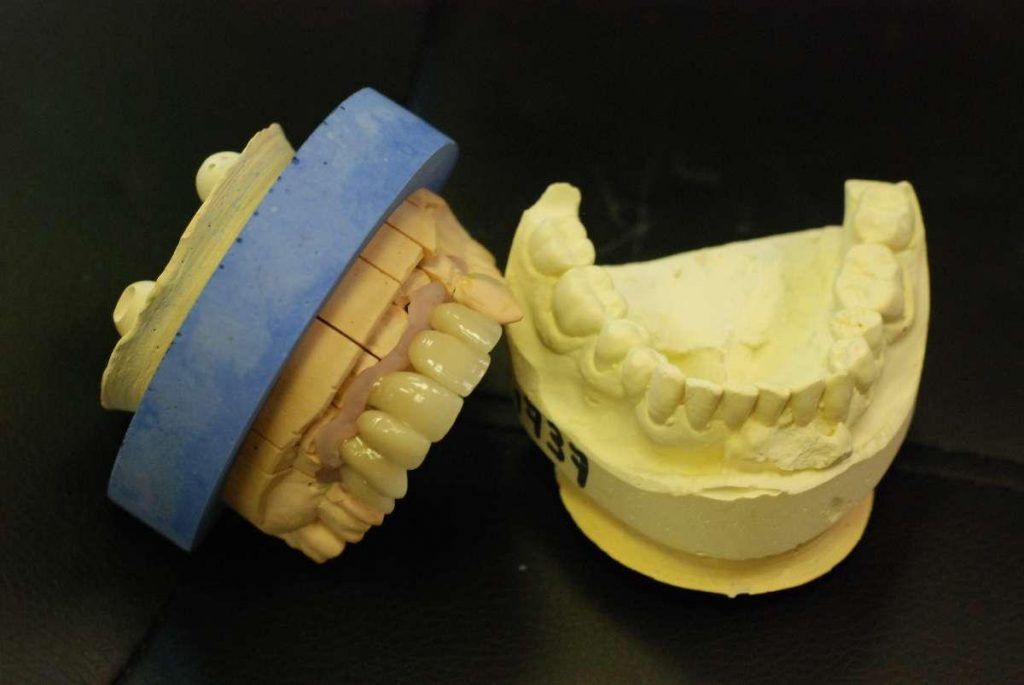 Prothèse conjointe de la mâchoire supérieure