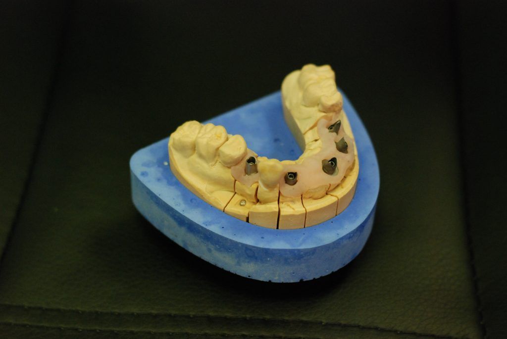 Cinq implants avant la pose d'une prothèse