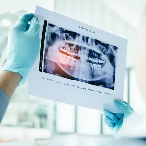 Una persona que lleva guantes azules sostiene una radiografía de sus dientes.