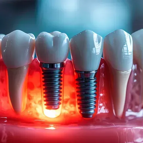 Un modelo de una fila de dientes con implantes dentales en ellos.