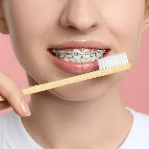 Una mujer con aparatos dentales se cepilla los dientes con un cepillo de dientes.