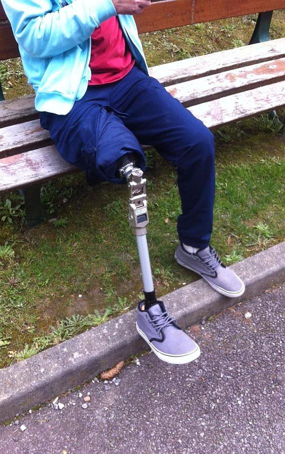 Réalisation d'une prothèse de jambe à Annecy avec Alpes Orthopédie
