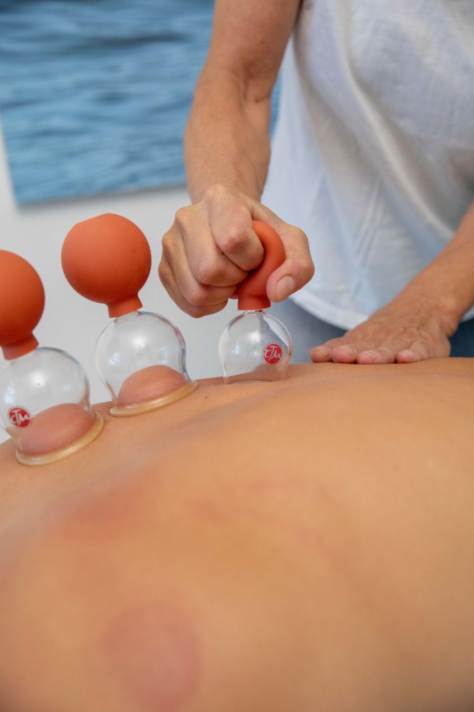 Eine Person erhält eine Schröpftherapie. Auf ihrem Rücken stehen mehrere Schröpfgläser, die von einer anderen Person bedient werden.