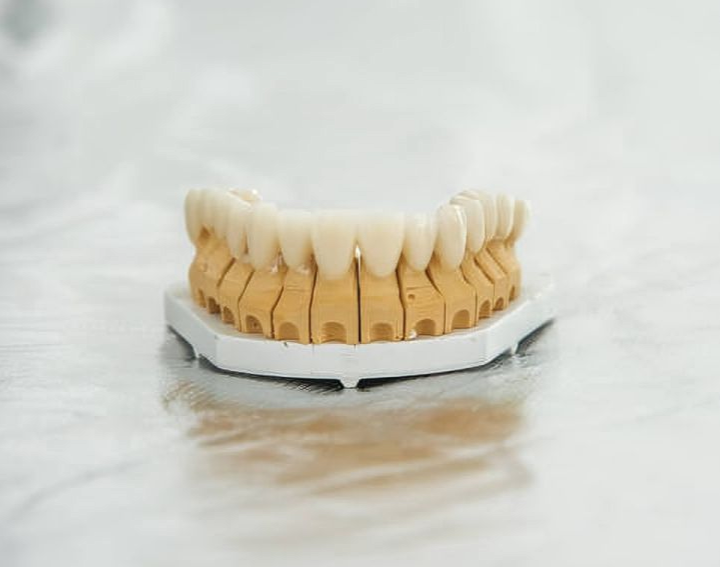 Modelo dentário mostrando um implante dentário com dentes e gengivas circundantes em corte transversal.