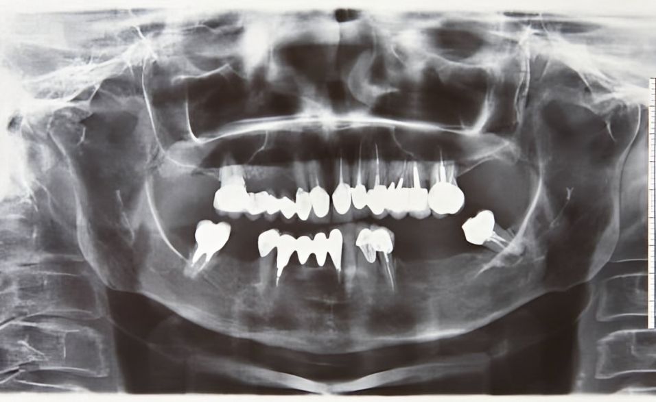 Dentista examinando os dentes de um paciente com um espelho e um palito. O paciente está com a boca aberta.