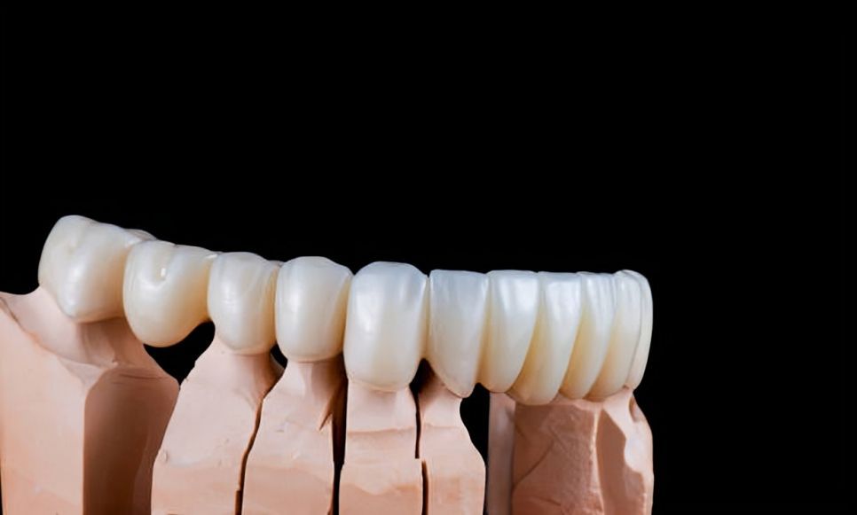 Dentista de luvas azuis, segurando um modelo odontológico e um retentor transparente em um ambiente clínico.