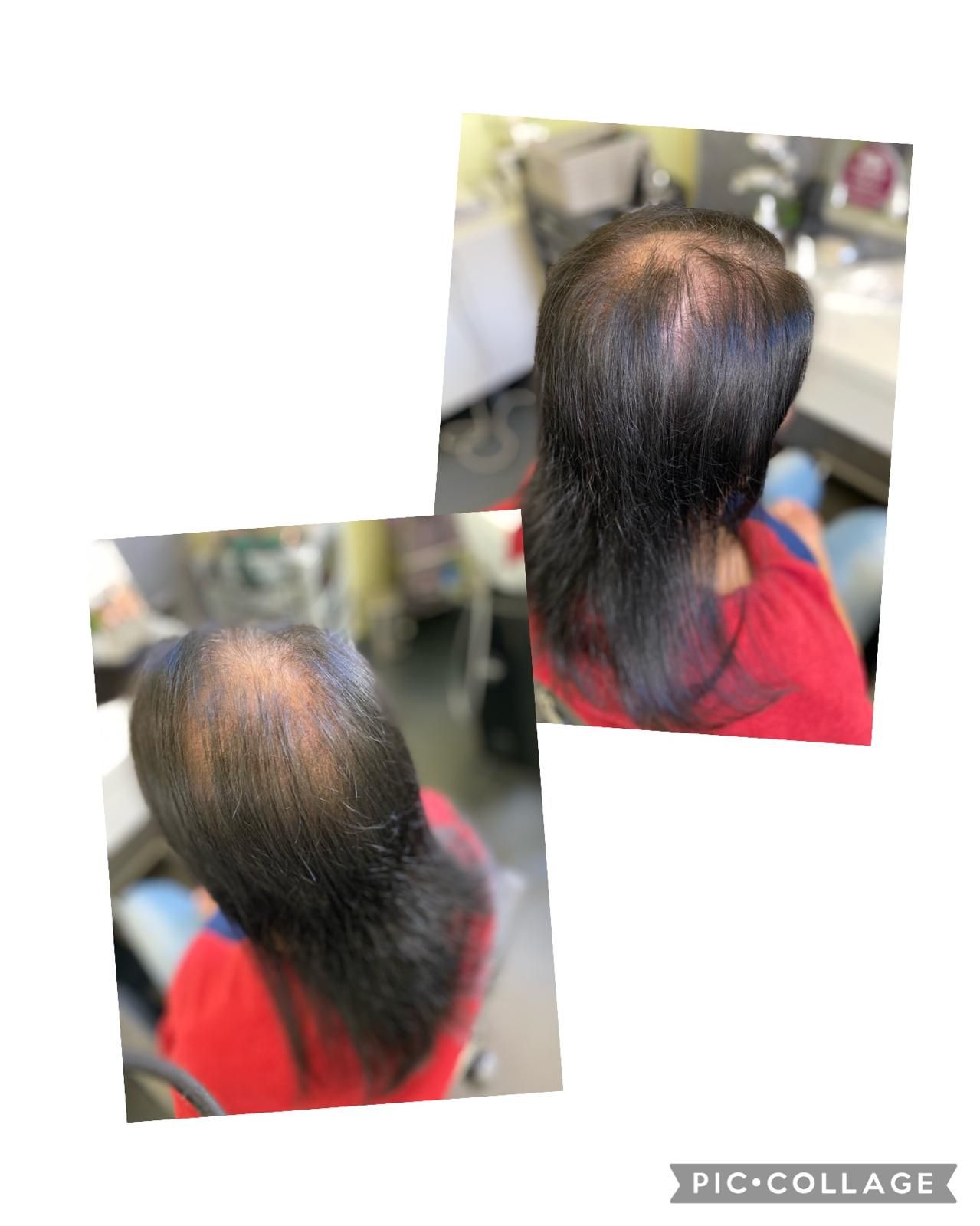 Zwei Aufnahmen von oben zeigen eine Person mit dunklem Haar, deren Kopfhaar lichter wird. Die Person befindet sich in einer salonähnlichen Umgebung.