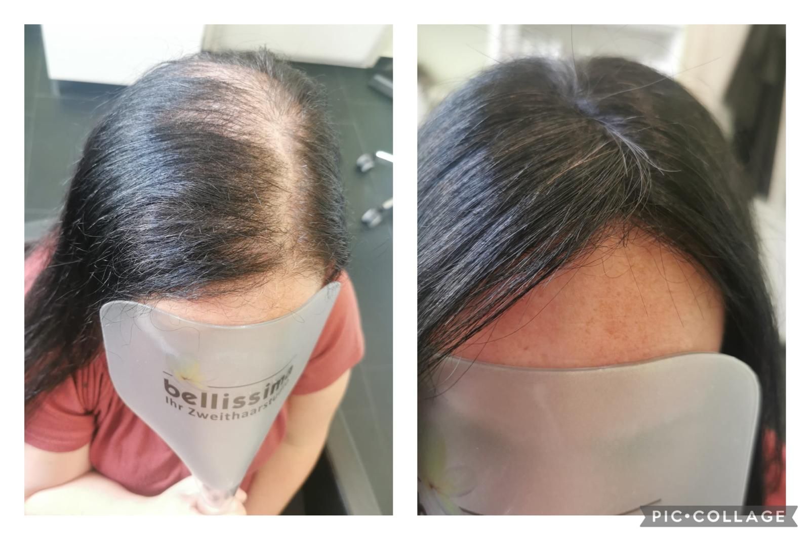 Zwei nebeneinanderliegende Bilder zeigen die Kopfhaut einer Frau vor und nach einer Haarbehandlung.