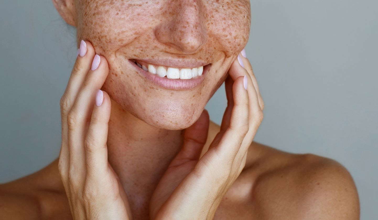 Personne au visage constellé de taches de rousseur, souriante, les mains sur les joues.