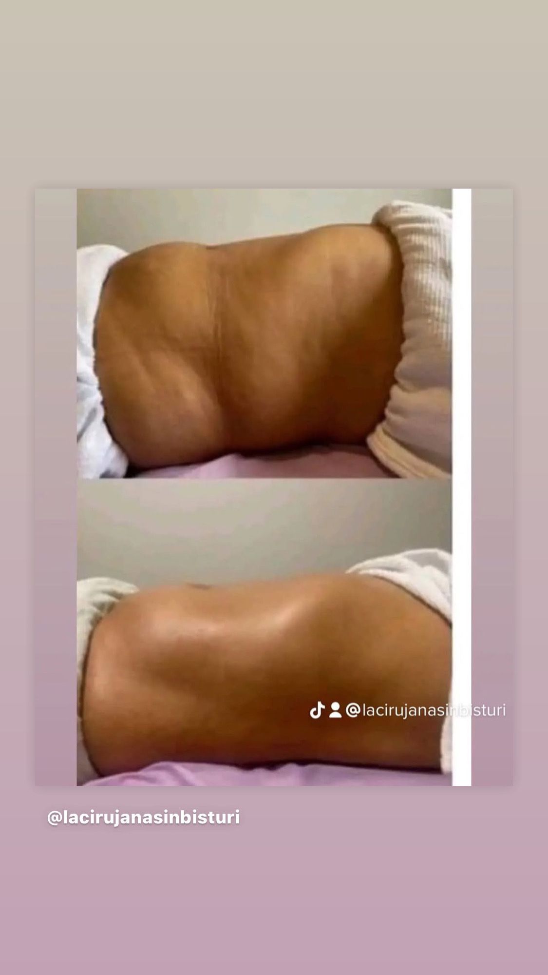 Una fotografía de antes y después del estómago de una mujer.