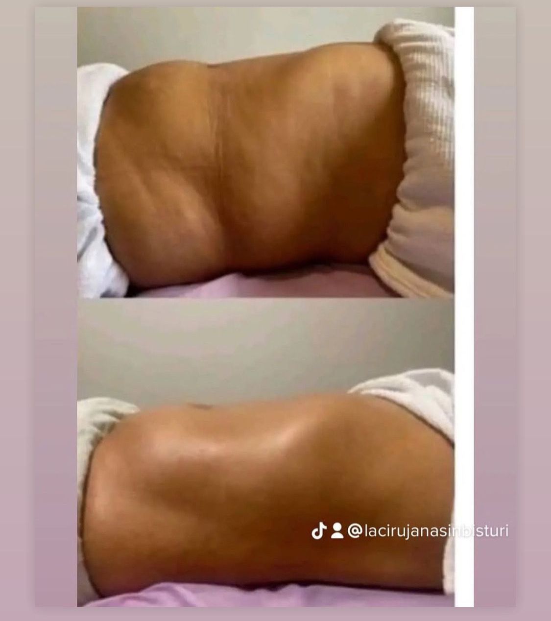 Una foto de antes y después de la espalda de una persona.