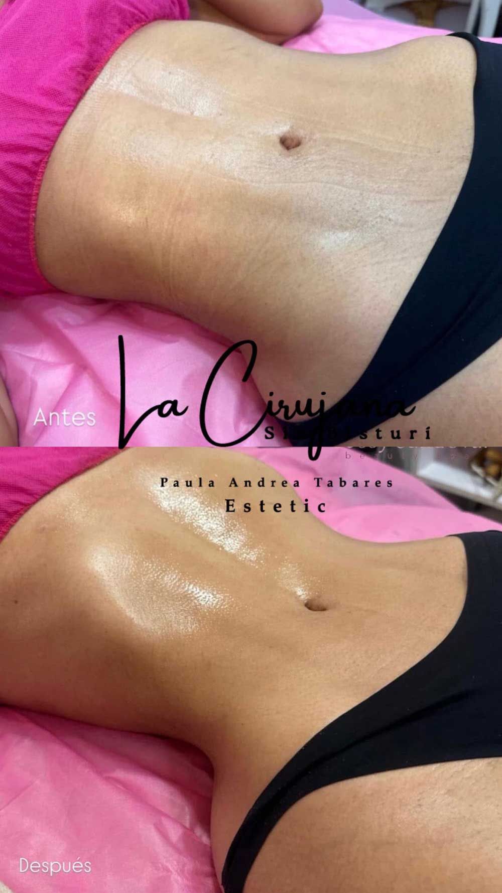 Una fotografía de antes y después del estómago de una mujer.