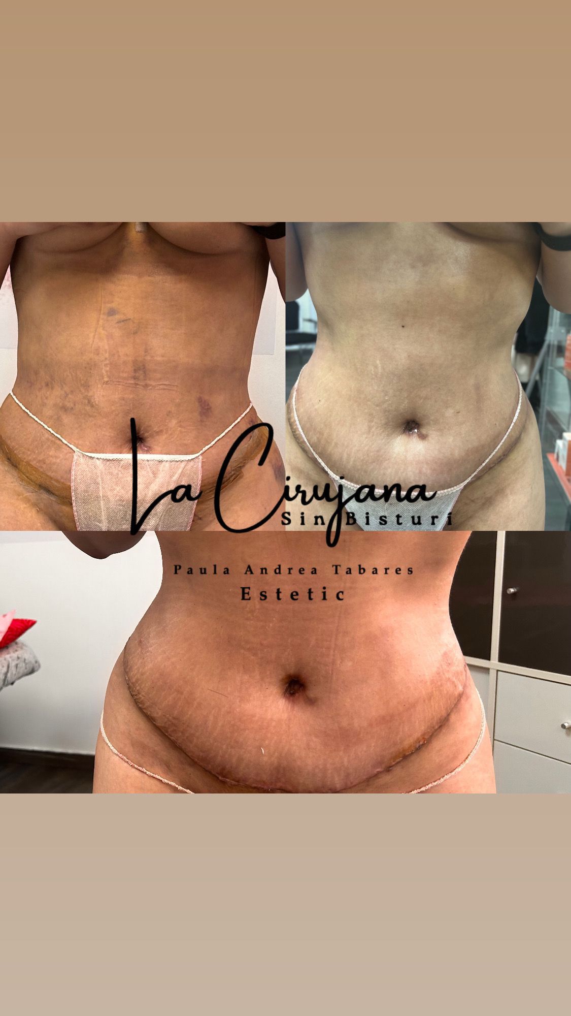 Se muestra el estómago de una mujer antes y después de la cirugía.