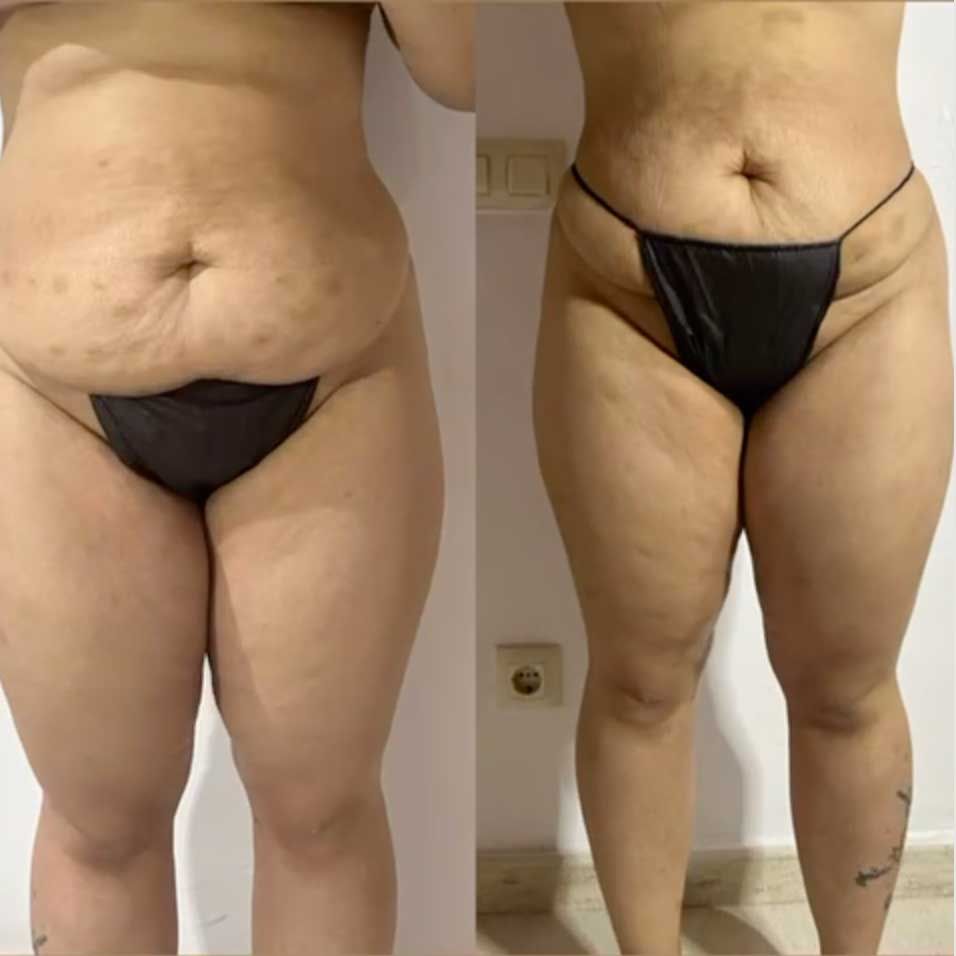 Una foto de antes y después de las piernas y los muslos de una mujer.
