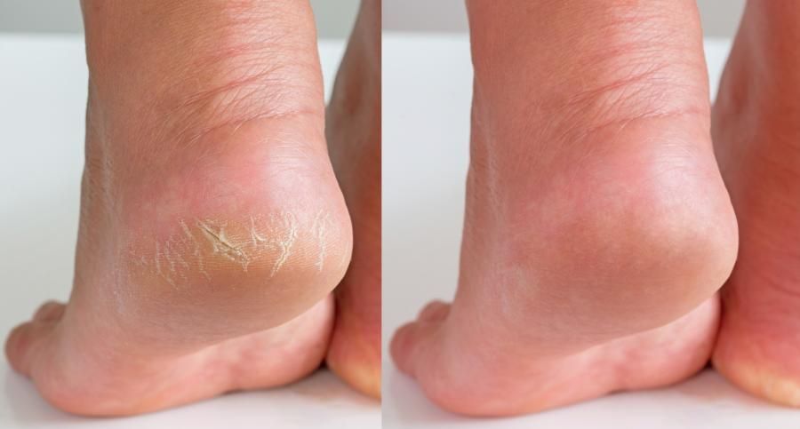 Bild vor und nach der Behandlung trockener Fersen, rissige Haut, dehydrierte Haut an den Fersen weiblicher Füße.