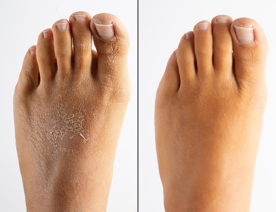 Nahaufnahme der Füße einer Frau vor und nach der Feuchtigkeitsbehandlung für trockene Haut mit Anti-Aging-Effekt. Beseitigung von Falten, Peeling und Dermatitis
