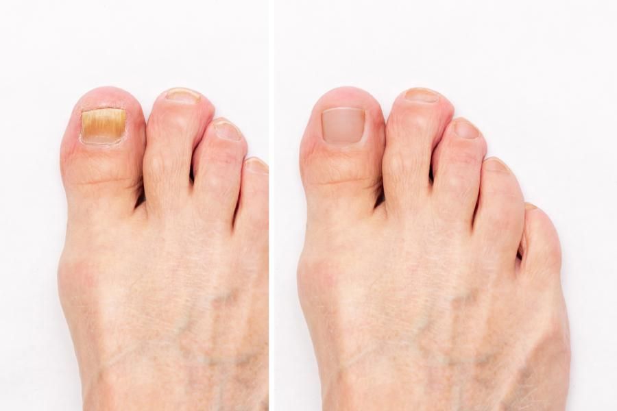Makroaufnahme eines männlichen Fußes mit gelbem, hässlichem Pilz auf Zehennägeln und gesunden Nägeln vor und nach der Behandlung, isoliert auf weißem Hintergrund. Nagelpilzinfektion. Fortgeschrittenes Krankheitsstadium. Ansicht von oben