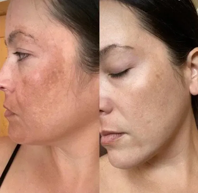 Se muestra el rostro de una mujer antes y después de un tratamiento.