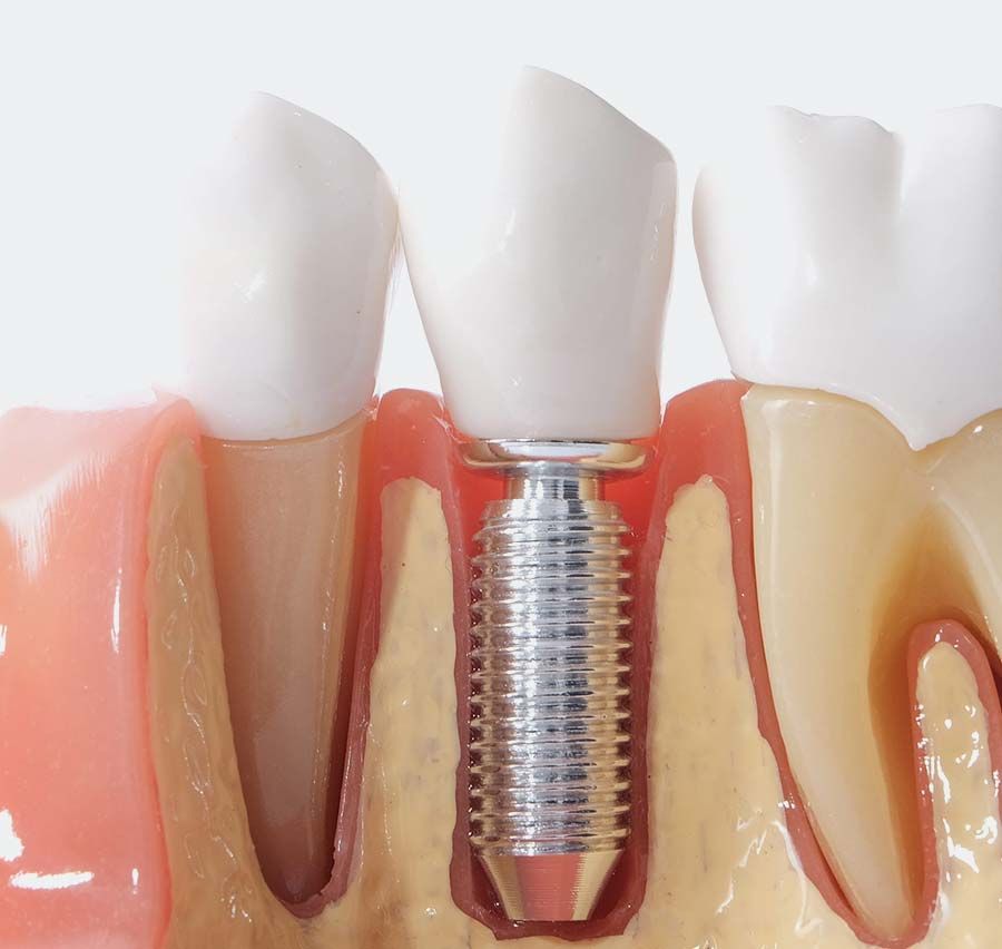 Ilustración de la sección transversal del tornillo del implante dental entre las encías y los dientes blancos.
