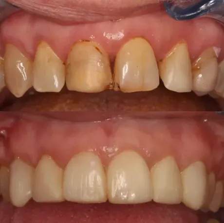 Primer plano de los dientes antes y después del blanqueamiento, mostrando los dientes superiores amarillentos y los inferiores más blancos.