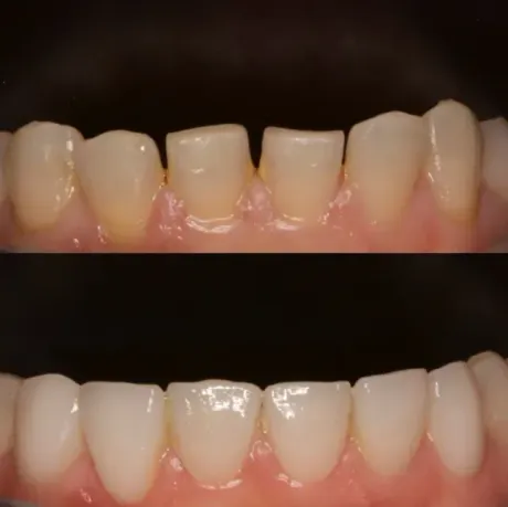 Primer plano de los dientes antes y después del blanqueamiento, donde la imagen inferior muestra dientes más brillantes y blancos.