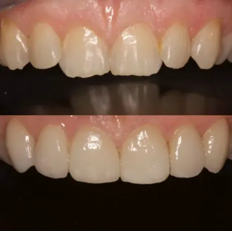 Primer plano de los dientes frontales superiores, antes y después del blanqueamiento o la restauración, sobre un fondo oscuro.
