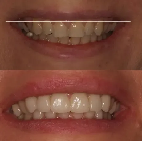 Primer plano de una boca sonriente que muestra los dientes antes y después del tratamiento de blanqueamiento.