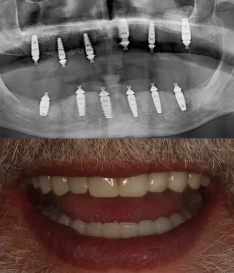 Radiografía dental arriba y primer plano de una boca sonriente con los dientes visibles abajo.