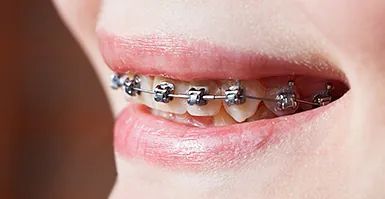 Un primer plano de la boca de una persona con aparatos dentales.