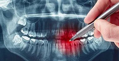 Una persona sostiene un bolígrafo sobre una radiografía de los dientes de una persona.