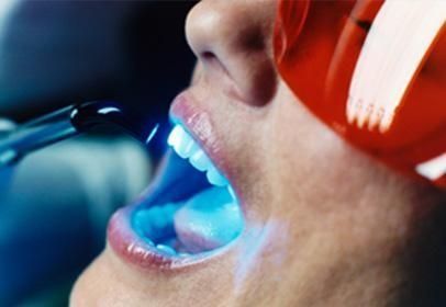 Persona sometida a tratamiento de blanqueamiento dental; la luz azul brilla sobre la boca abierta.