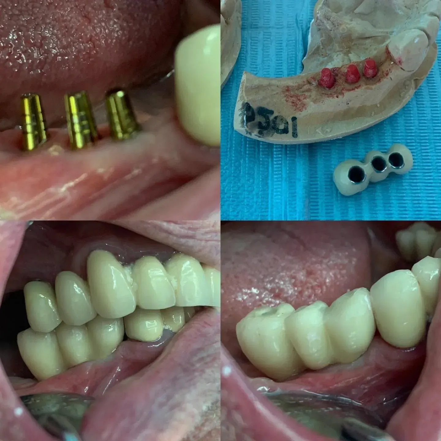 Un collage de cuatro imágenes de los dientes de una persona, incluida una que dice