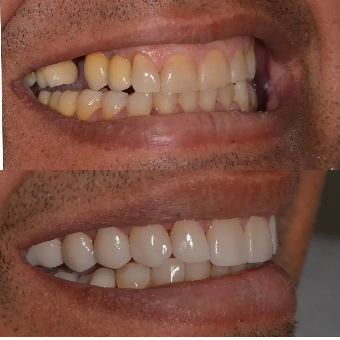 Una foto de antes y después de los dientes de un hombre.