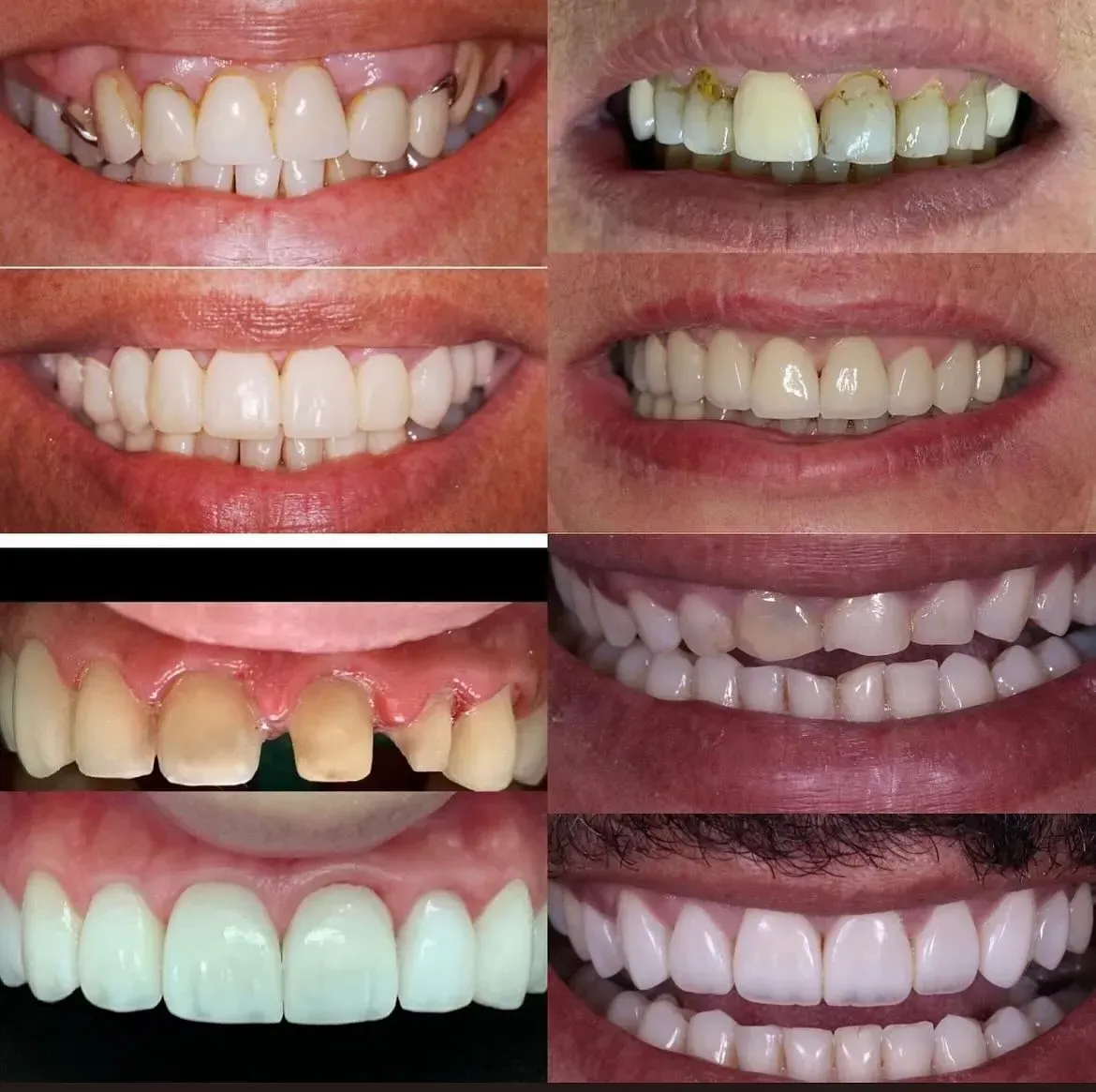 Un collage de cuatro imágenes de los dientes de una persona.