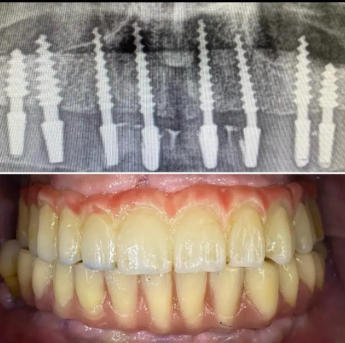 Una radiografía de los dientes de una persona y una fotografía de sus dientes.