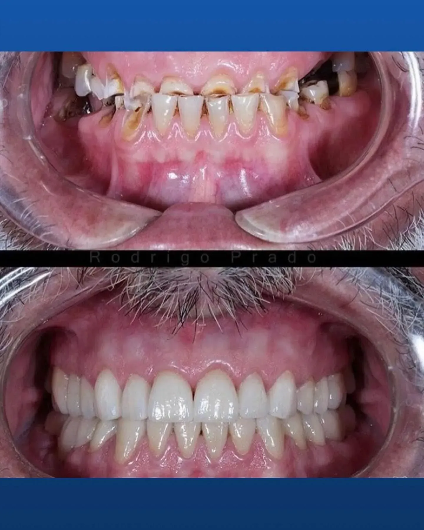 Una fotografía de antes y después de los dientes de una persona.