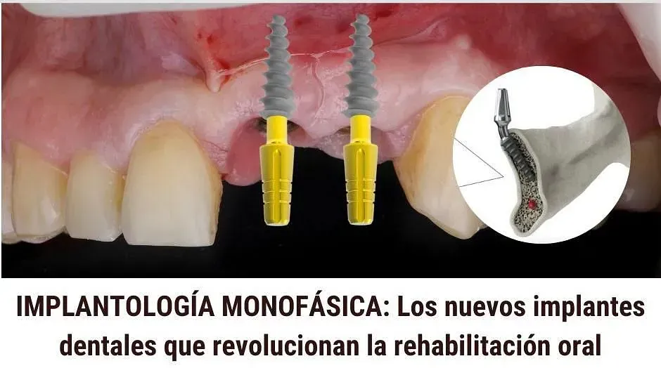Una imagen de la boca de una persona con dos implantes dentales en ella.
