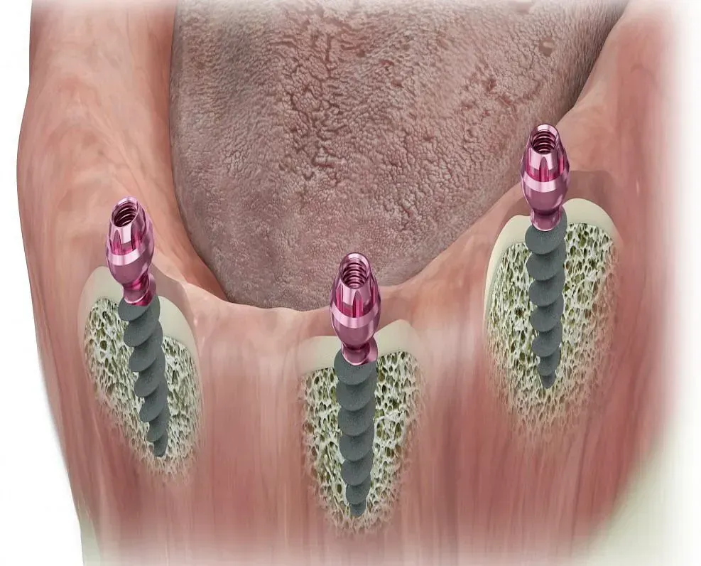 Un dibujo de tres implantes dentales en la boca de una persona.